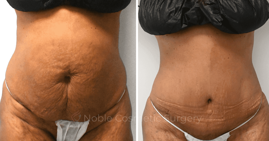 TUMMY-TUCK-CASE-10626 | Before and After Abdominoplasty