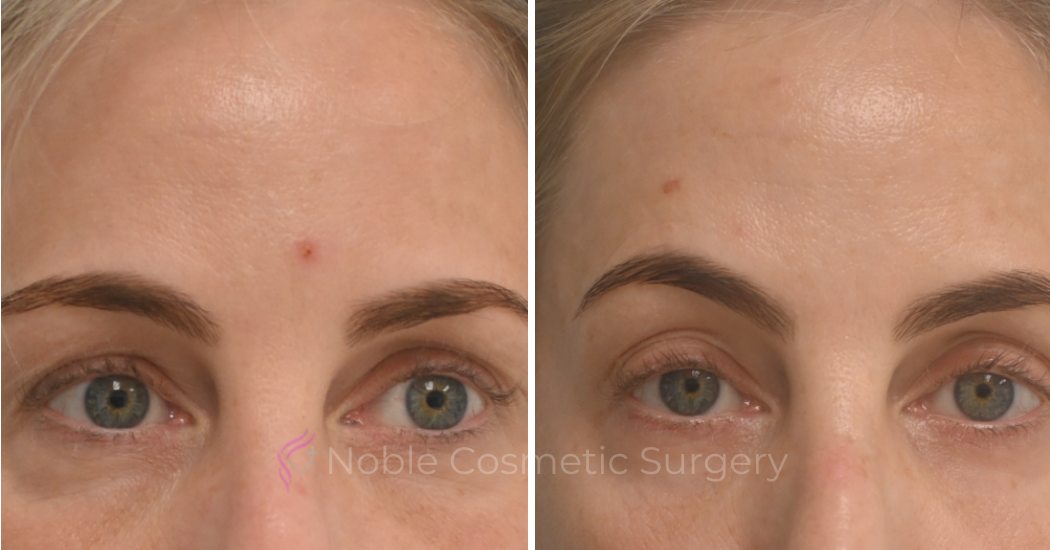 BLEPHAROPLASTY-CASE-10182 | Before and After Blepharoplasty