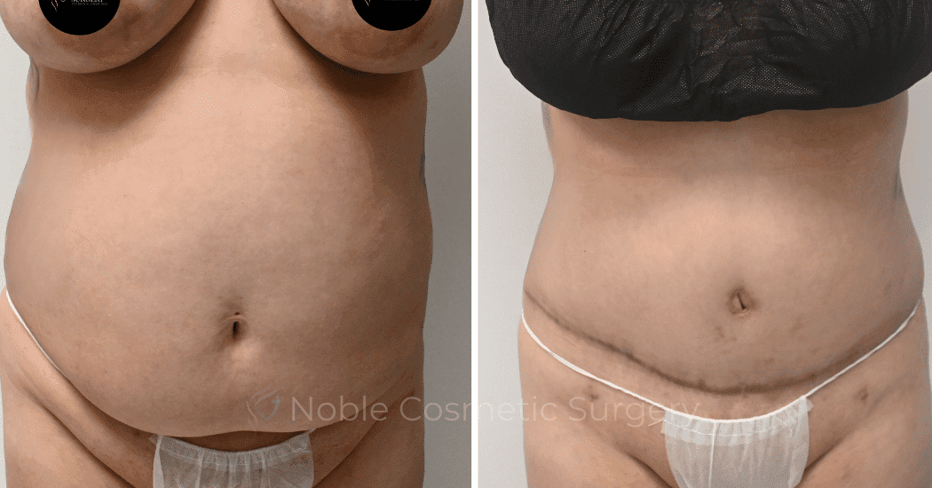 TUMMY-TUCK-CASE-10538 | Before and After Abdominoplasty