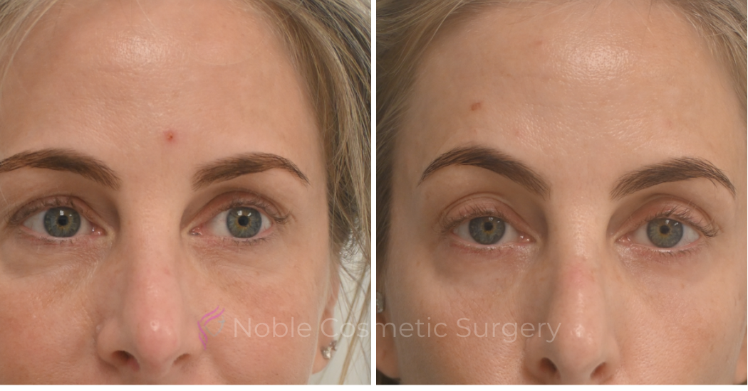 LIQUID-RHINOPLASTY-CASE-10007 | Before and After Liquid Rhinoplasty