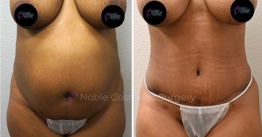 TUMMY-TUCK-CASE-00034 | Before and After Abdominoplasty 1