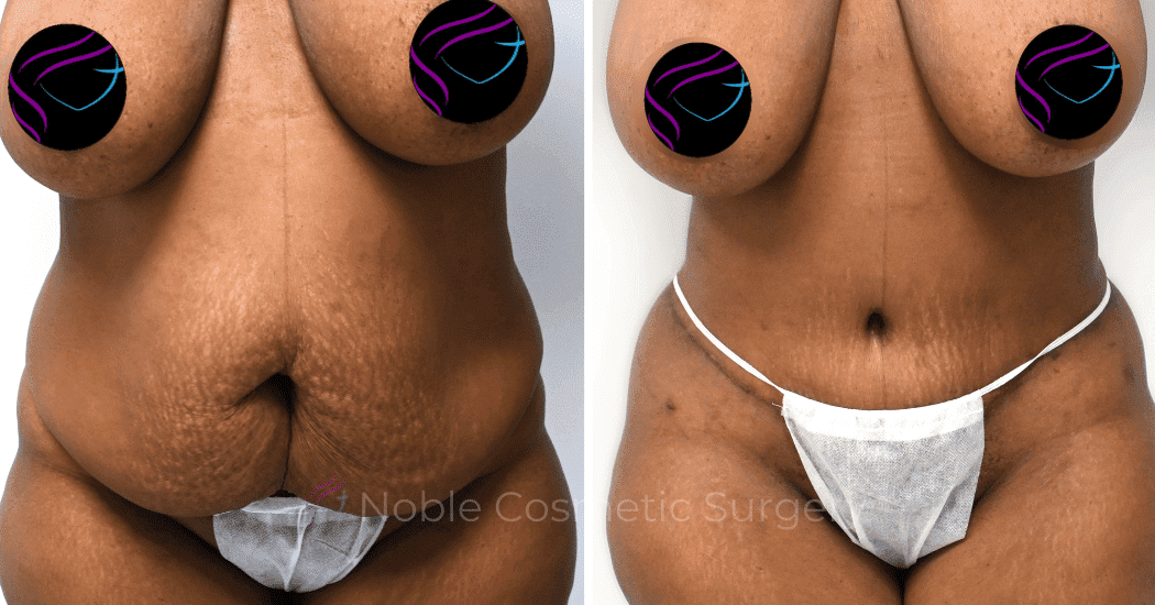 TUMMY-TUCK-CASE-14435 | Before and After Abdominoplasty