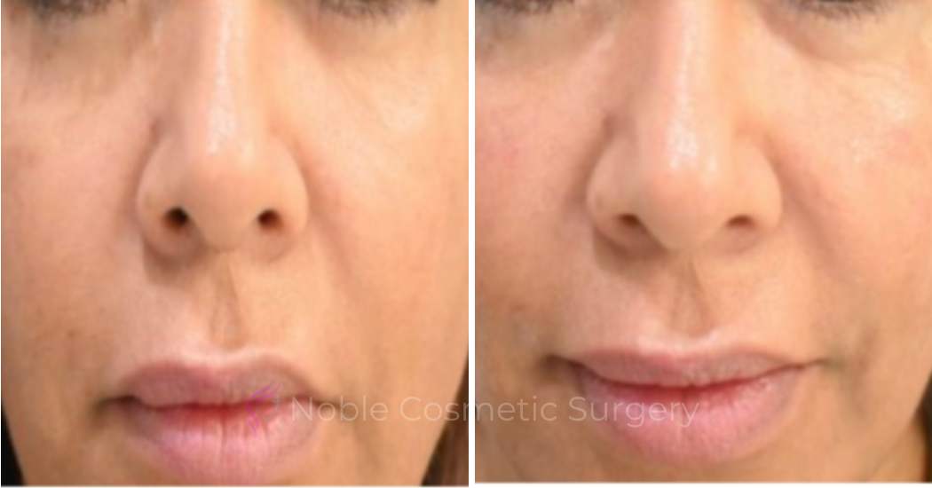 LIQUID-RHINOPLASTY-CASE-10004 | Before and After Liquid Rhinoplasty