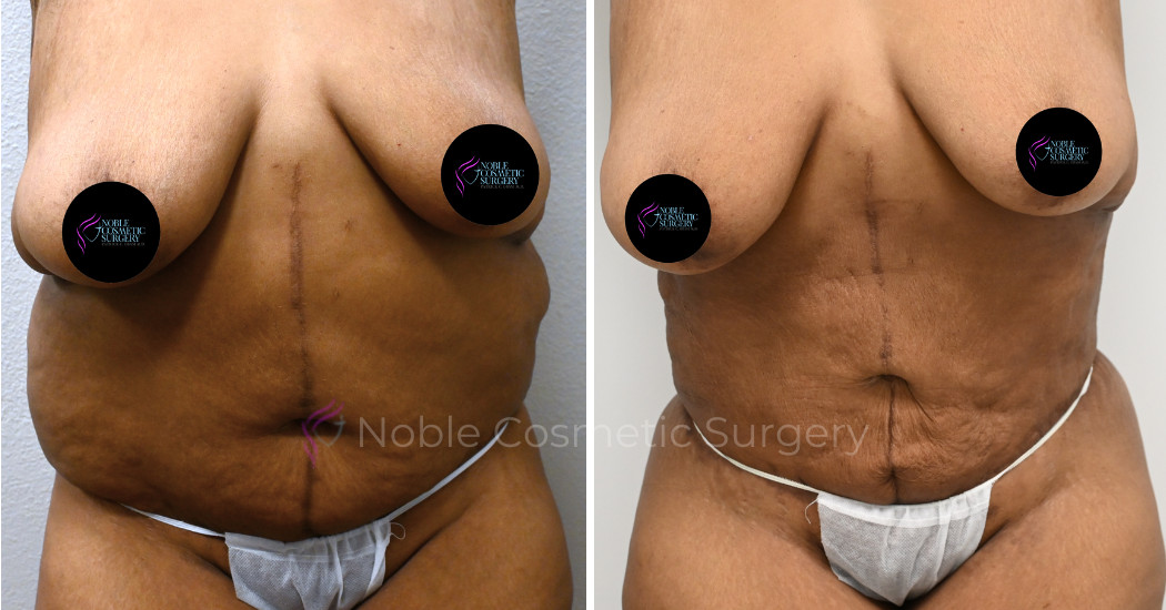 TUMMY-TUCK-CASE-00036 | Before and After Abdominoplasty 1