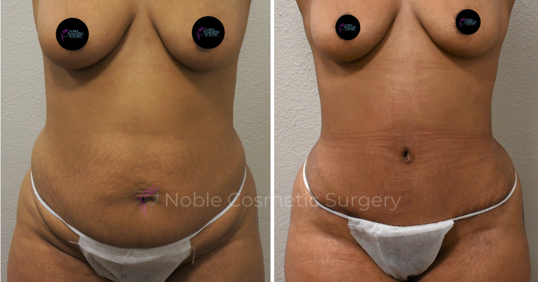 TUMMY-TUCK-CASE-00040 | Before and After Abdominoplasty 1