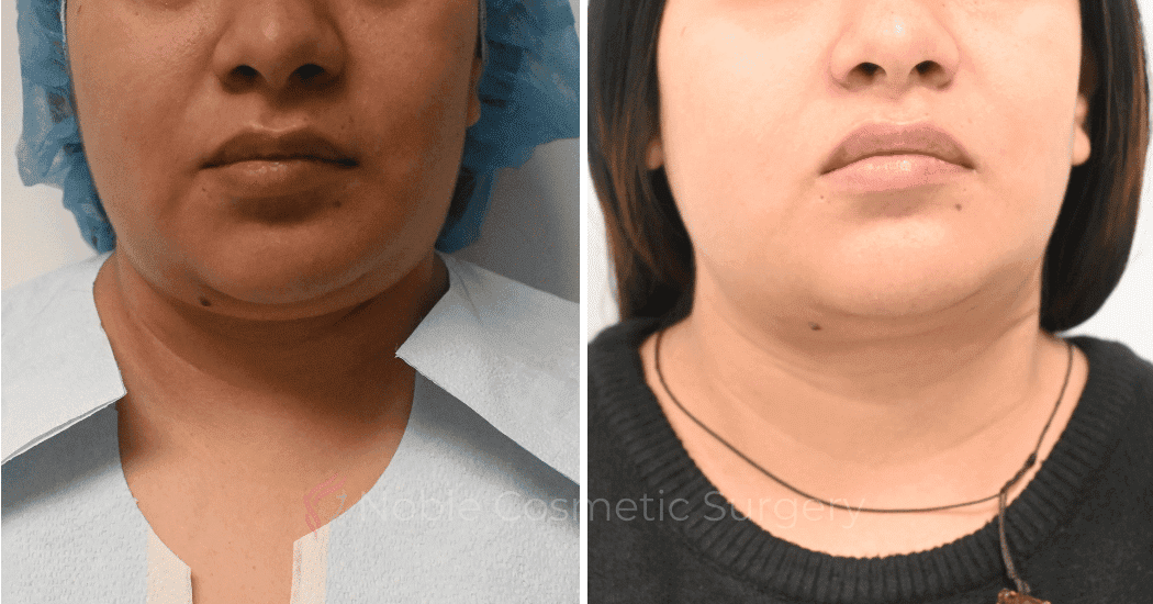 SUBMENTAL-LIPOSUCTION-CASE-10071 | Before and After Chin Liposuction