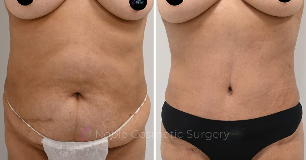 TUMMY-TUCK-CASE-00324 | Before and After Abdominoplasty 1