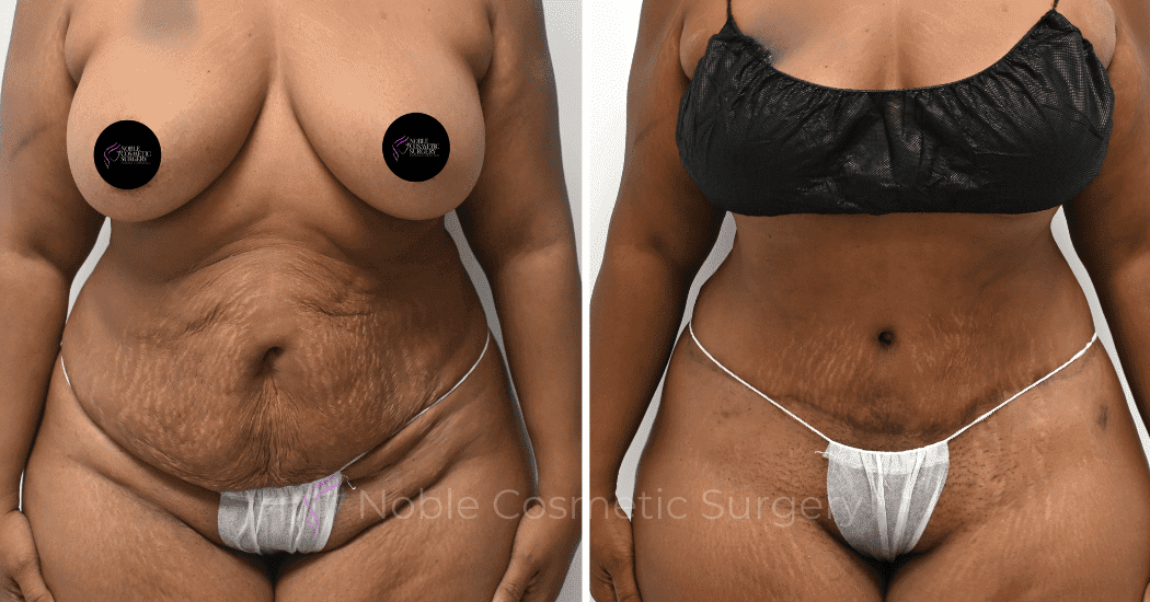 TUMMY-TUCK-CASE-14814 | Before and After Abdominoplasty