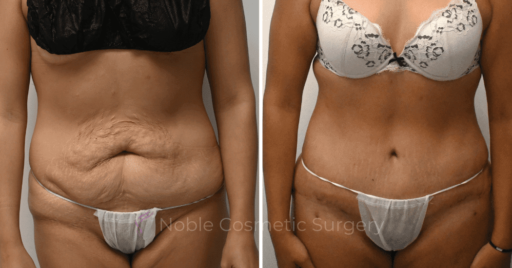 TUMMY-TUCK-CASE-12792 | Before and After Abdominoplasty 1