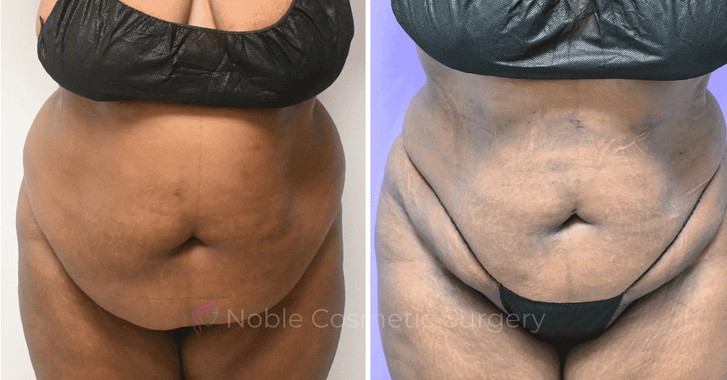 LIPOSUCTION-ABDOMEN-CASE-19096 | Before and After Liposuction