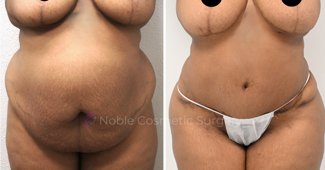 TUMMY-TUCK-CASE-00038 | Before and After Abdominoplasty 1