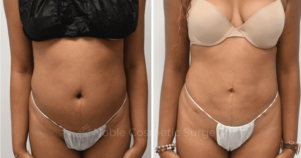 LIPOSUCTION-ABDOMEN-CASE--10533 | Before and After Liposuction