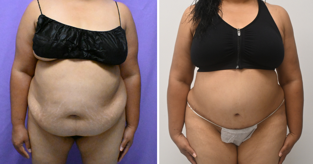 Case--10177 | Before and After Abdominoplasty 1