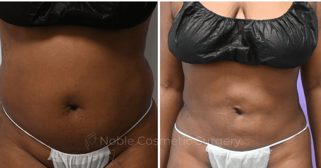 LIPOSUCTION-ABDOMEN-CASE-10873 | Before and After Liposuction