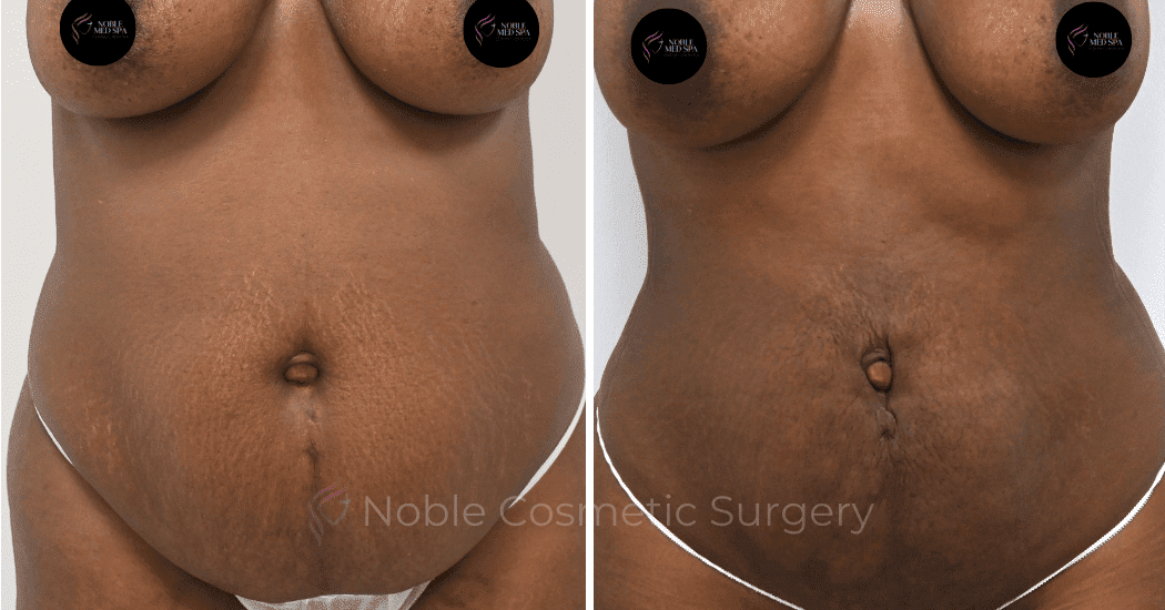 LIPOSUCTION-ABDOMEN-CASE-12901 | Before and After Liposuction