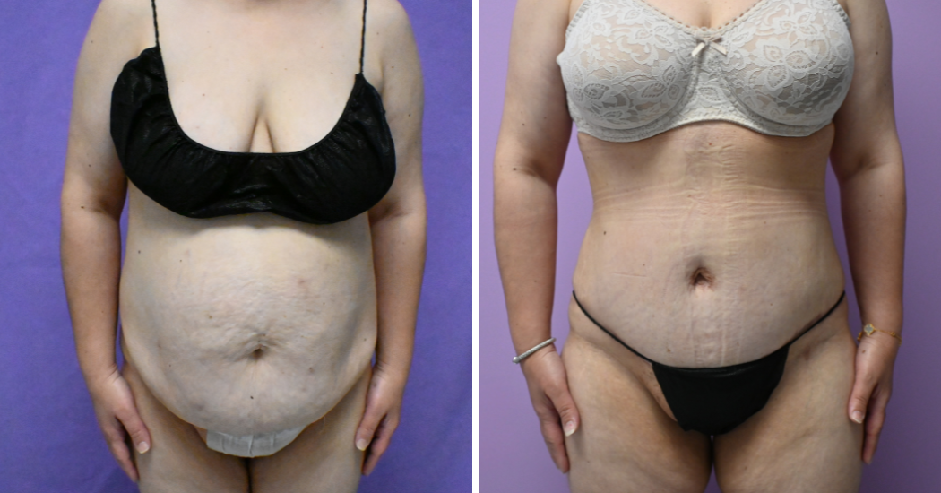 Case--19794 | Before and After Abdominoplasty 1