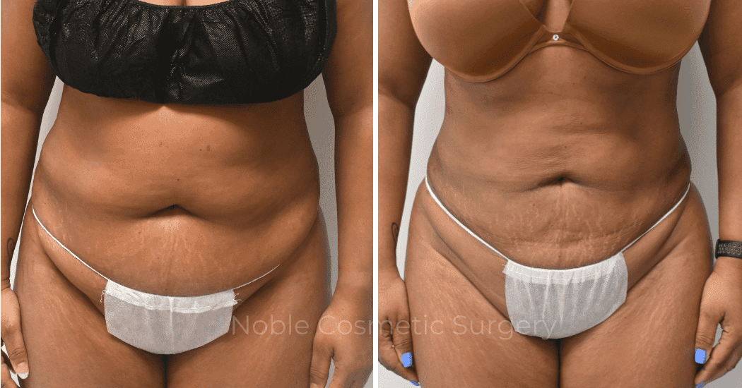 LIPOSUCTION-ABDOMEN-CASE-16787 | Before and After Liposuction