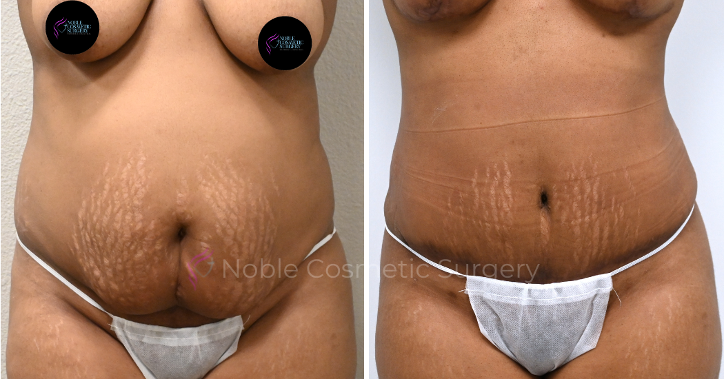 TUMMY-TUCK-CASE-00037 | Before and After Abdominoplasty 1