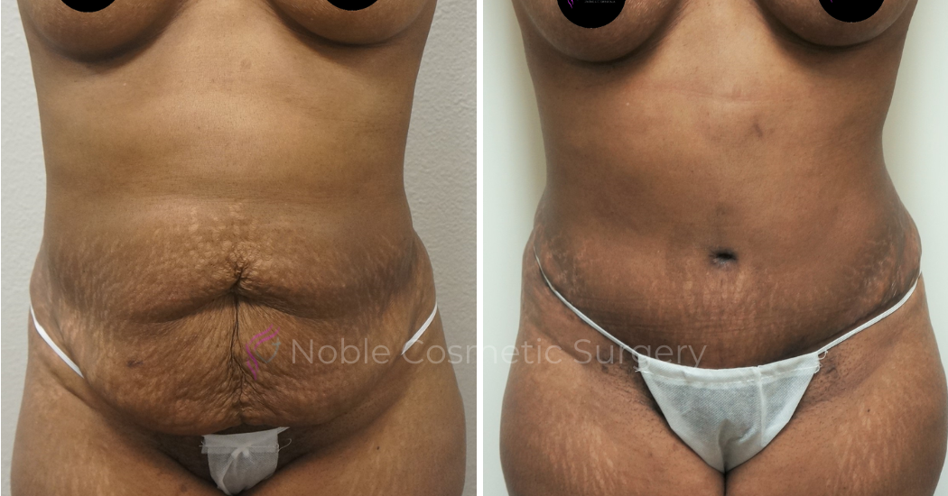 TUMMY-TUCK-CASE-00041 | Before and After Abdominoplasty 1