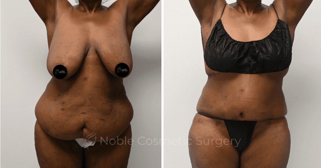 TUMMY-TUCK-CASE-11910 | Before and After Abdominoplasty