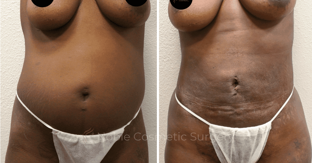 LIPOSUCTION-ABDOMEN-CASE-15104 | Before and After Liposuction