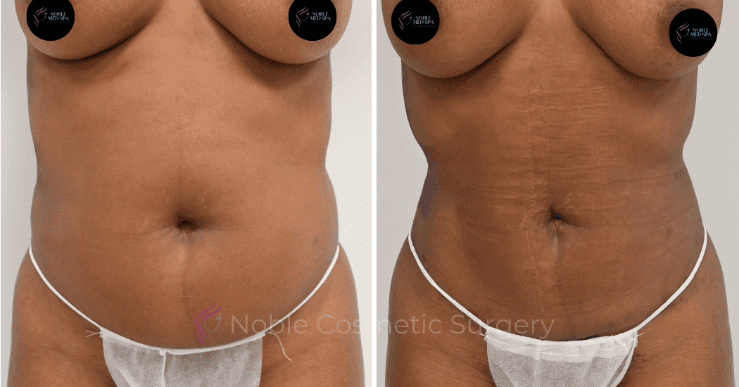 LIPOSUCTION-ABDOMEN-CASE-12590 | Before and After Liposuction
