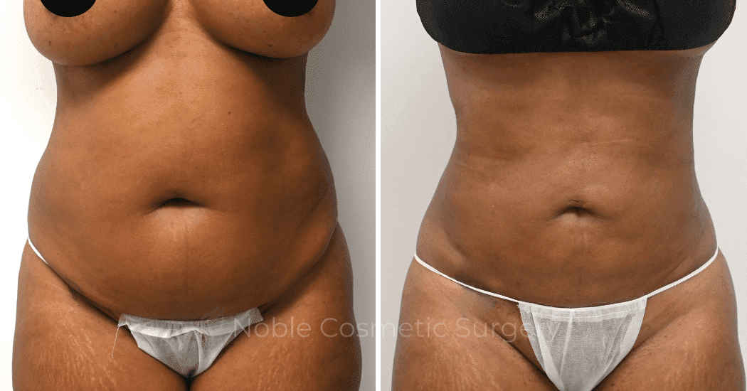 LIPOSUCTION-ABDOMEN-CASE-11016 | Before and After Liposuction
