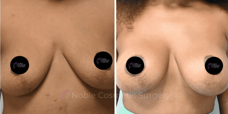 BREAST-AUGMENTATION-CASE-11356 | Before and After Breast Augmentation