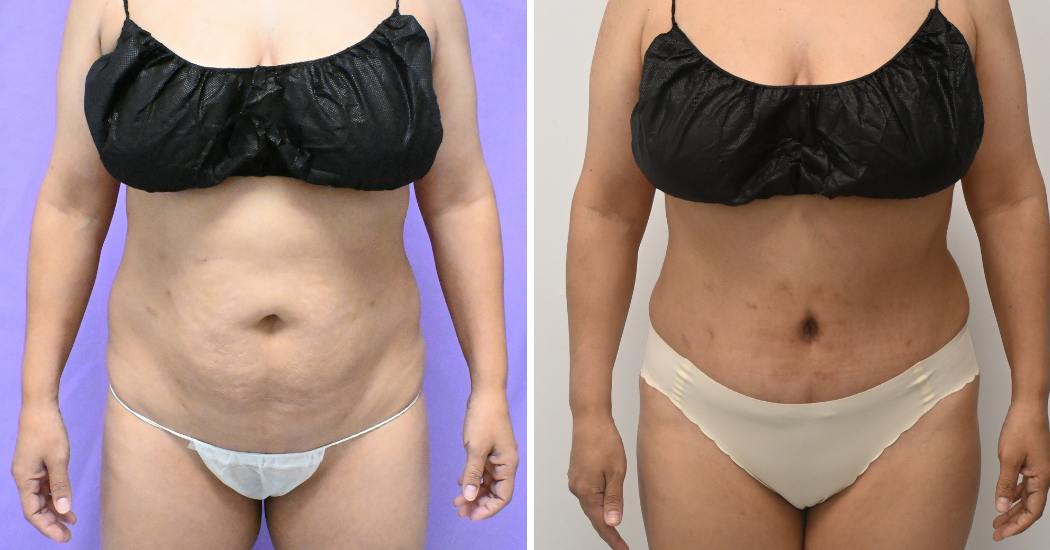 Case--20157 | Before and After Abdominoplasty 1