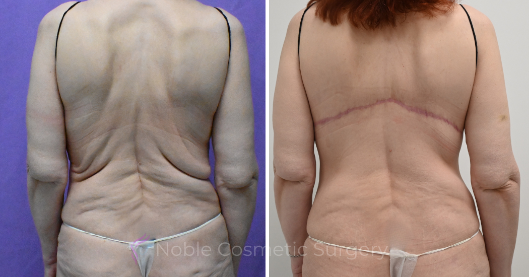Case--12099 | Before and After Back Lift