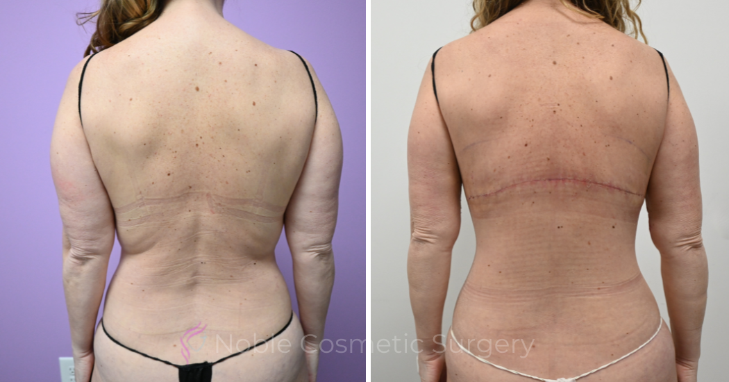 Case--20309 | Before and After Back Lift