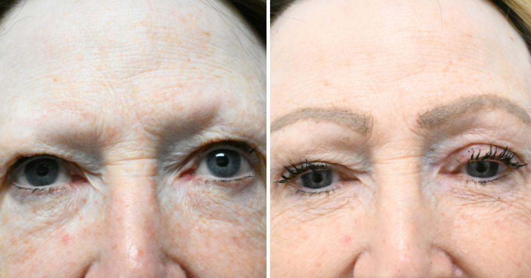 Case--18940 | Before and After Blepharoplasty