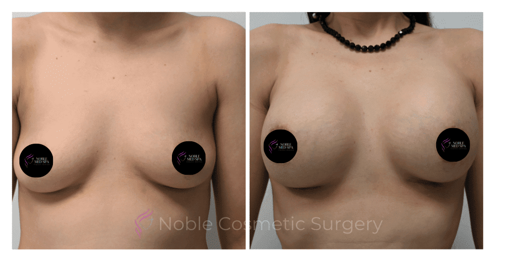 BREAST-AUGMENTATION-CASE-11661 | Before and After Breast Augmentation