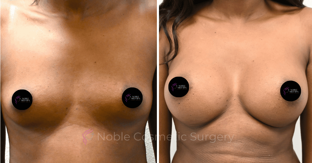 BREAST-AUGMENTATION-CASE-13251 | Before and After Breast Augmentation