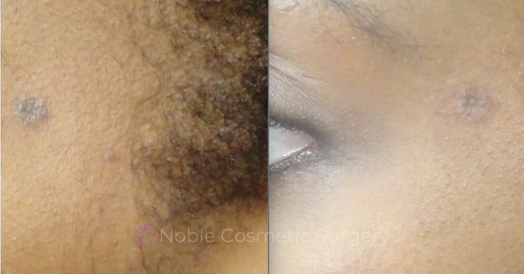 PICO-LASER-CASE-00001 | Before and After Pico Skin Rejuvenation 2