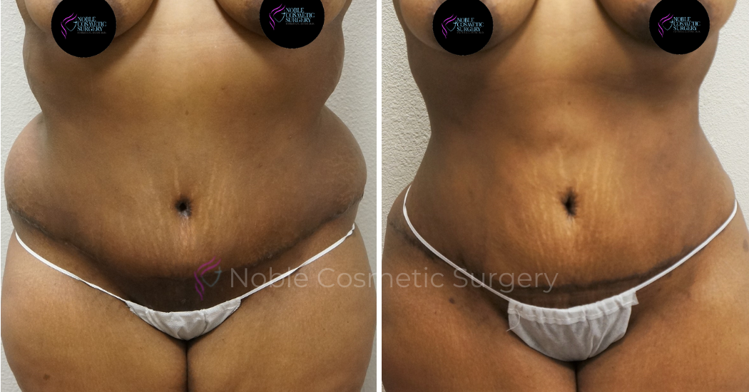 TUMMY-TUCK-CASE-00042 | Before and After Abdominoplasty 1