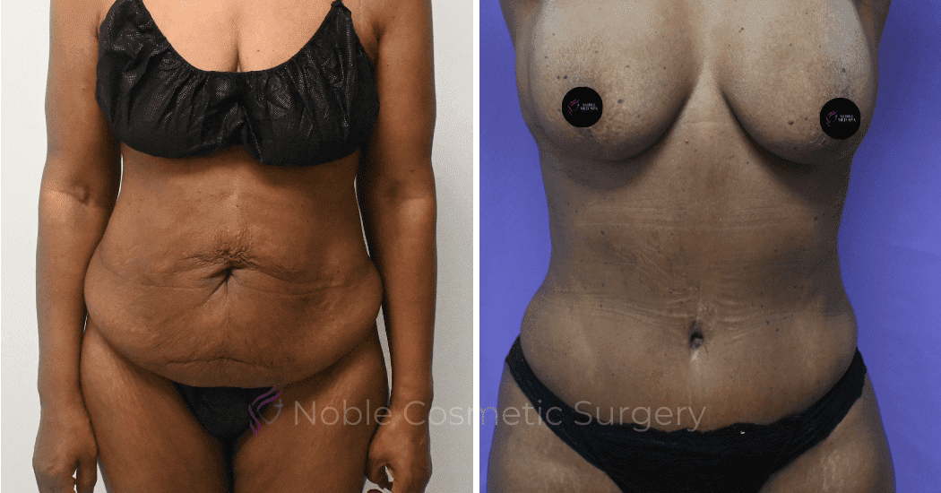 TUMMY-TUCK-CASE-10375 | Before and After Abdominoplasty