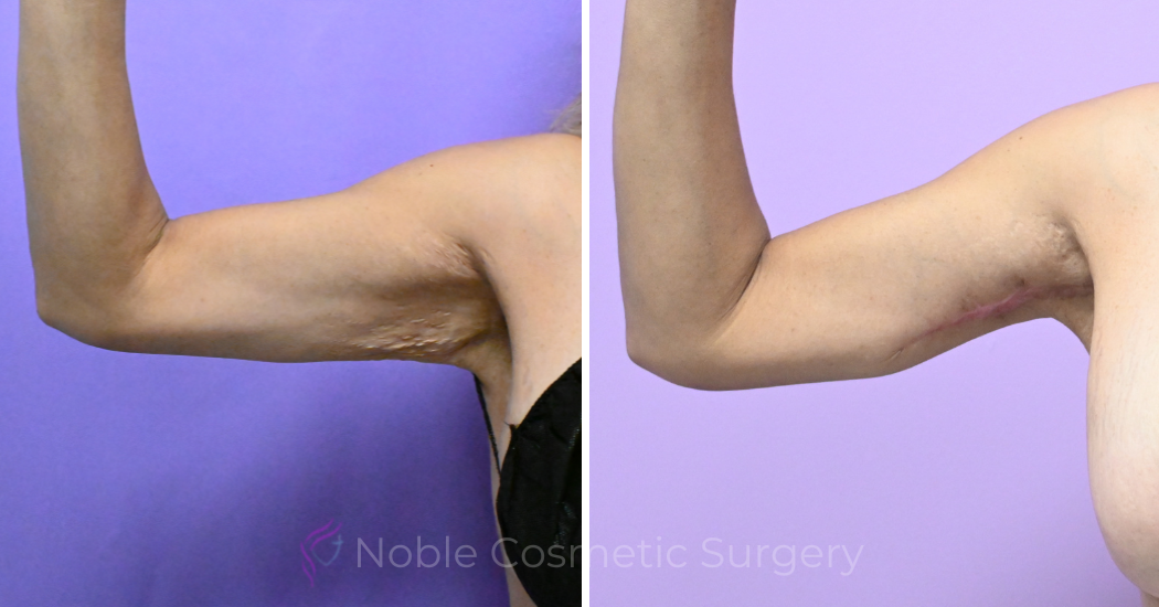 Case--20186 | Before and After Brachioplasty