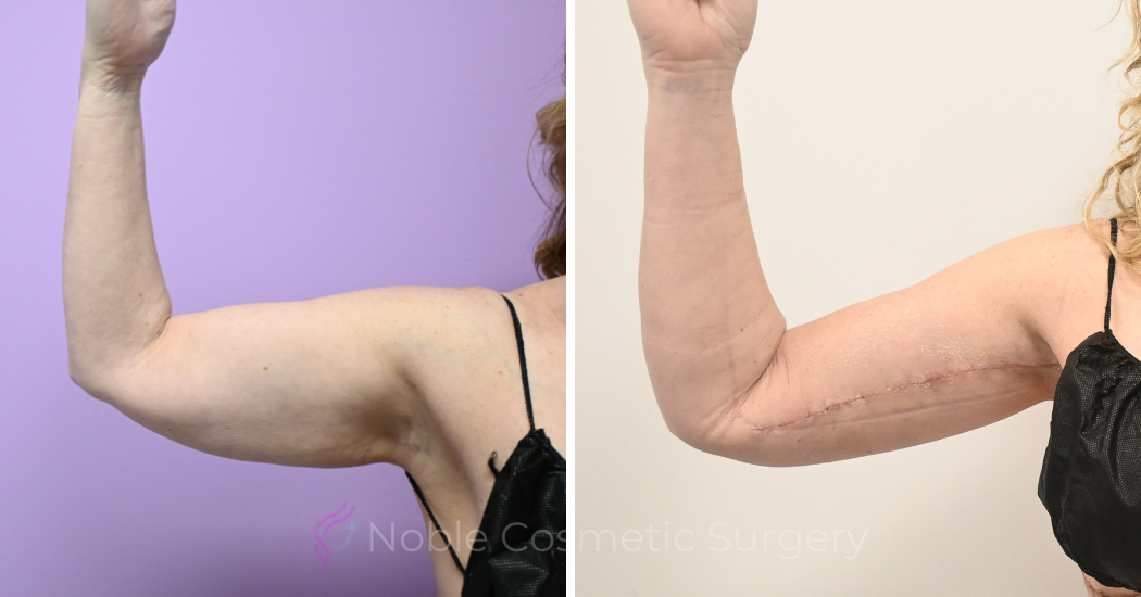 Case--20309 | Before and After Brachioplasty