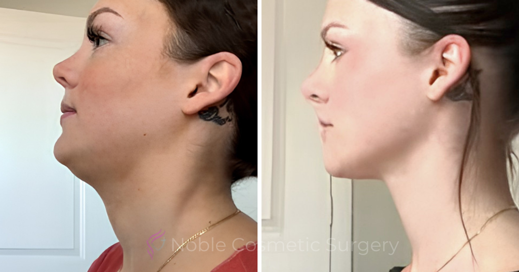 Case--20184 | Before and After Chin Liposuction