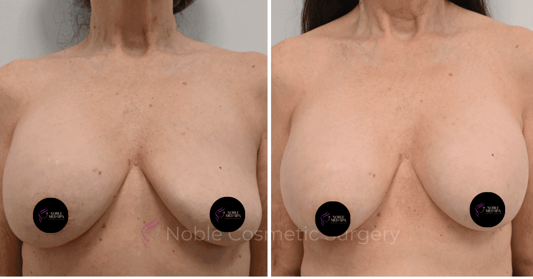 BREAST-AUGMENTATION-CASE-12085 | Before and After Breast Augmentation