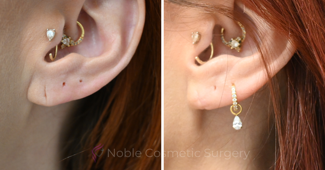 Case--20318 | Before and After Earlobe Repair