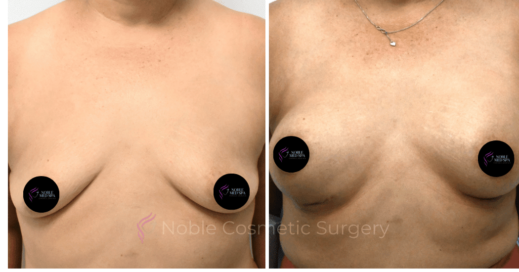 BREAST-AUGMENTATION-CASE-10545 | Before and After Breast Augmentation