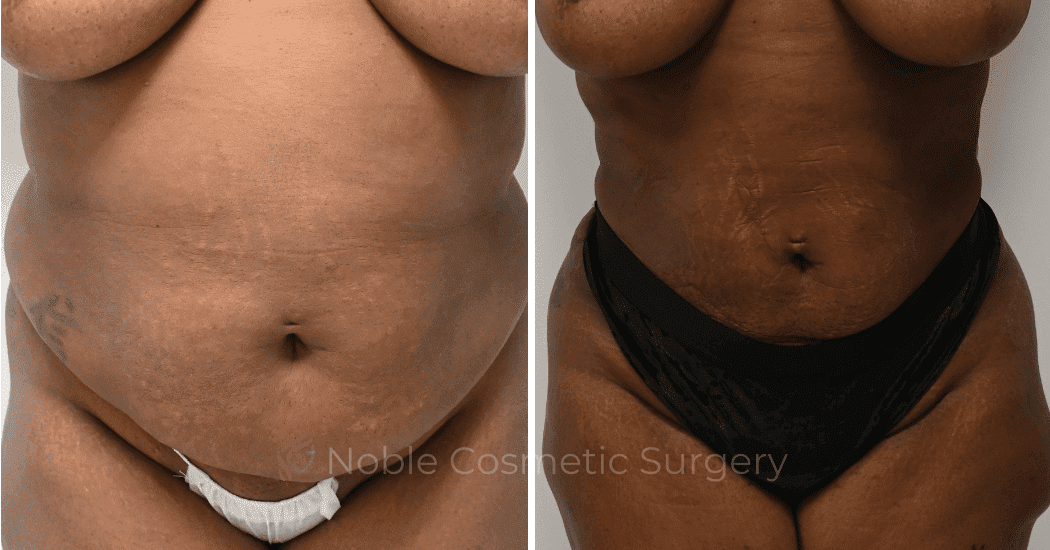LIPOSUCTION-ABDOMEN-CASE-15837 | Before and After Liposuction