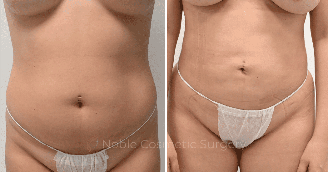 LIPOSUCTION-CASE-11801 | Before and After Liposuction