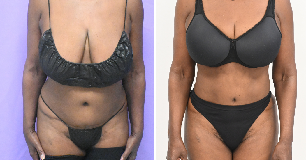 Case--19632 | Before and After Liposuction 1