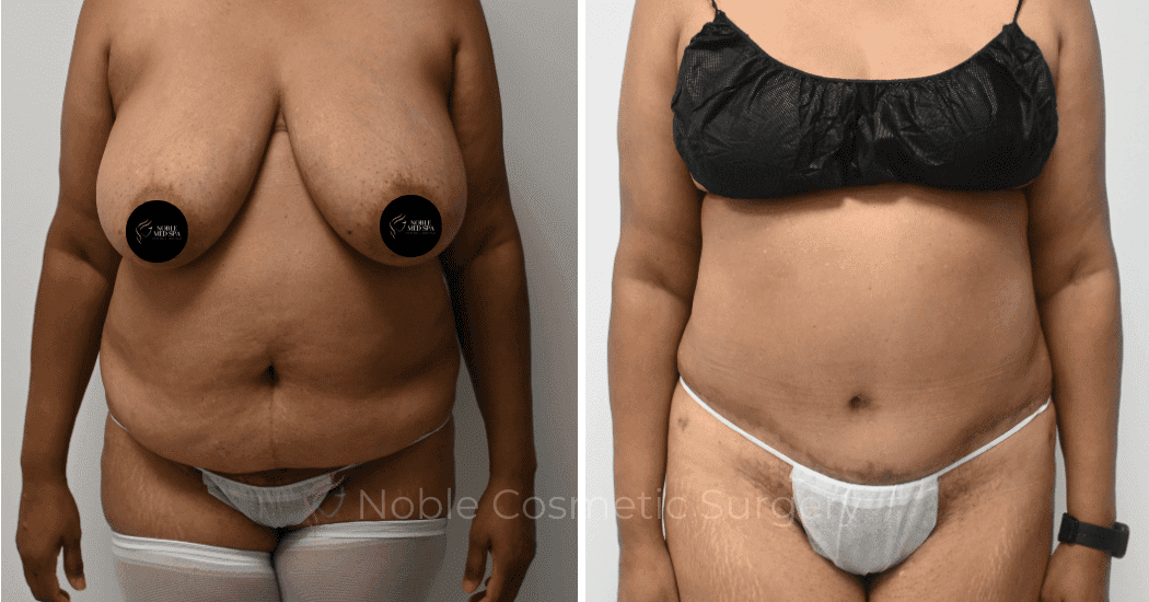 TUMMY-TUCK-CASE-11110 | Before and After Abdominoplasty