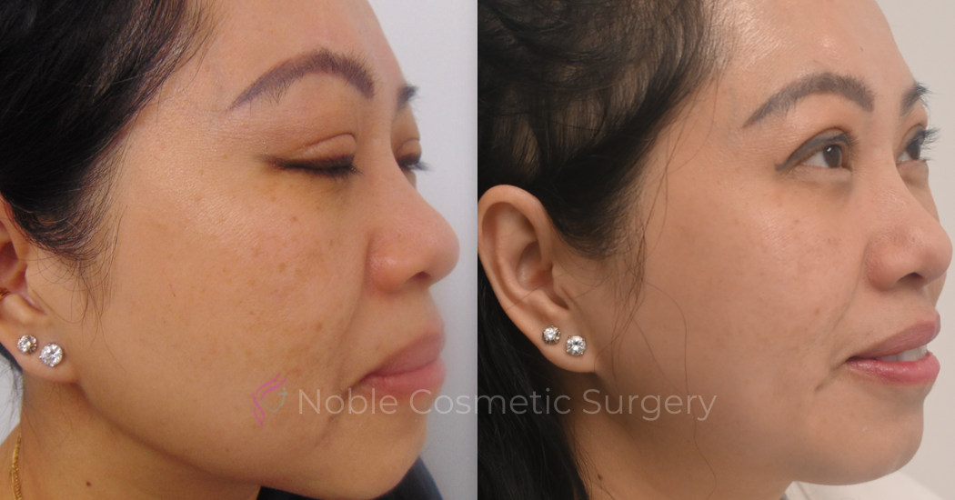 PICO-LASER-CASE-00003 | Before and After Pico Skin Rejuvenation