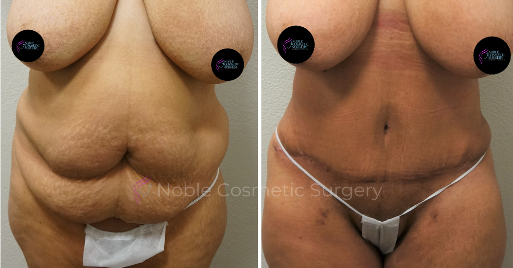 TUMMY-TUCK-CASE-00043 | Before and After Abdominoplasty 1