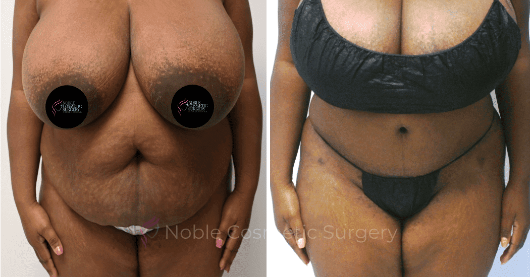 TUMMY-TUCK-CASE-11720 | Before and After Abdominoplasty